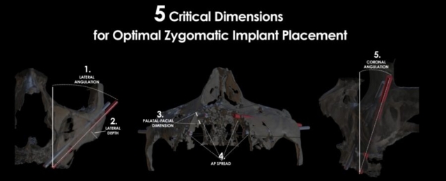 Optimal Zygomatic Implant Placement