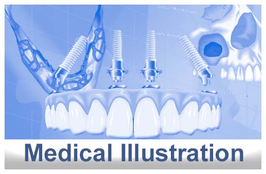 Medical Illustration 3D Modeling Surgical Guide Design