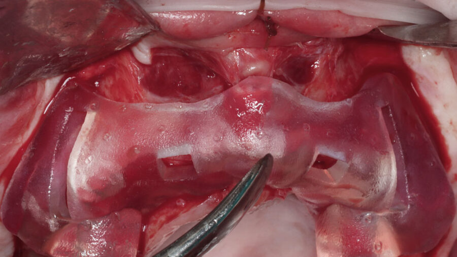 plan clin large singles clin tilted