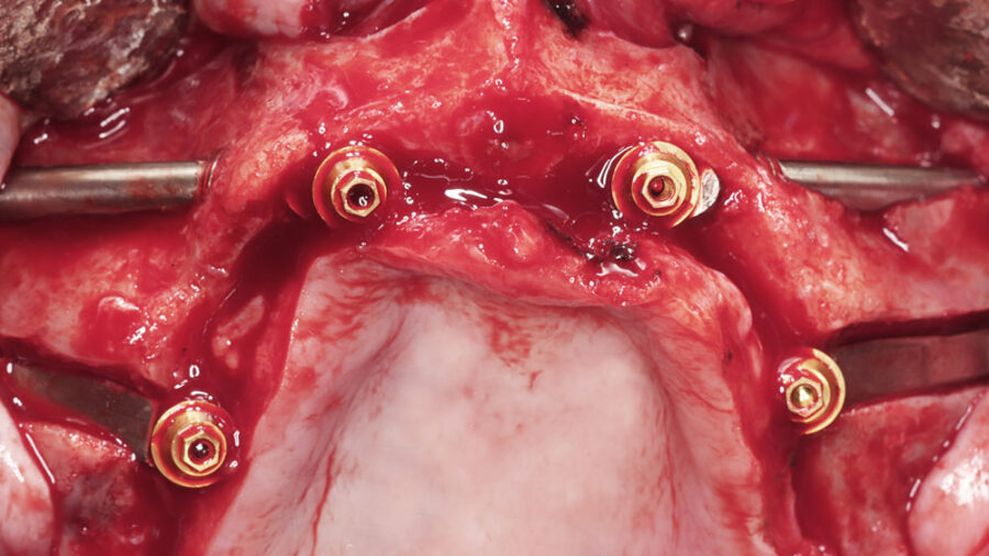 plan clin large singles clin zygomatic