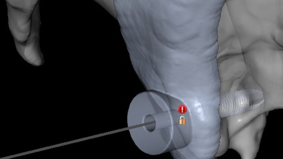 plan clin large singles plan pterygoid