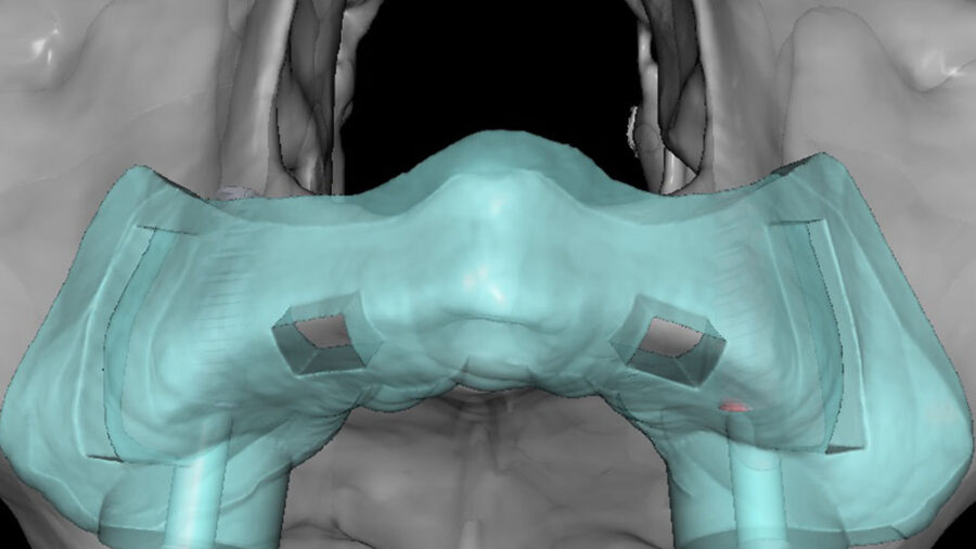 plan clin large singles plan tilted