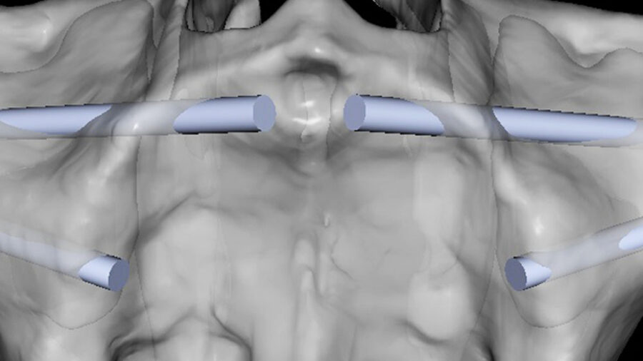 plan clin large singles plan zygomatic